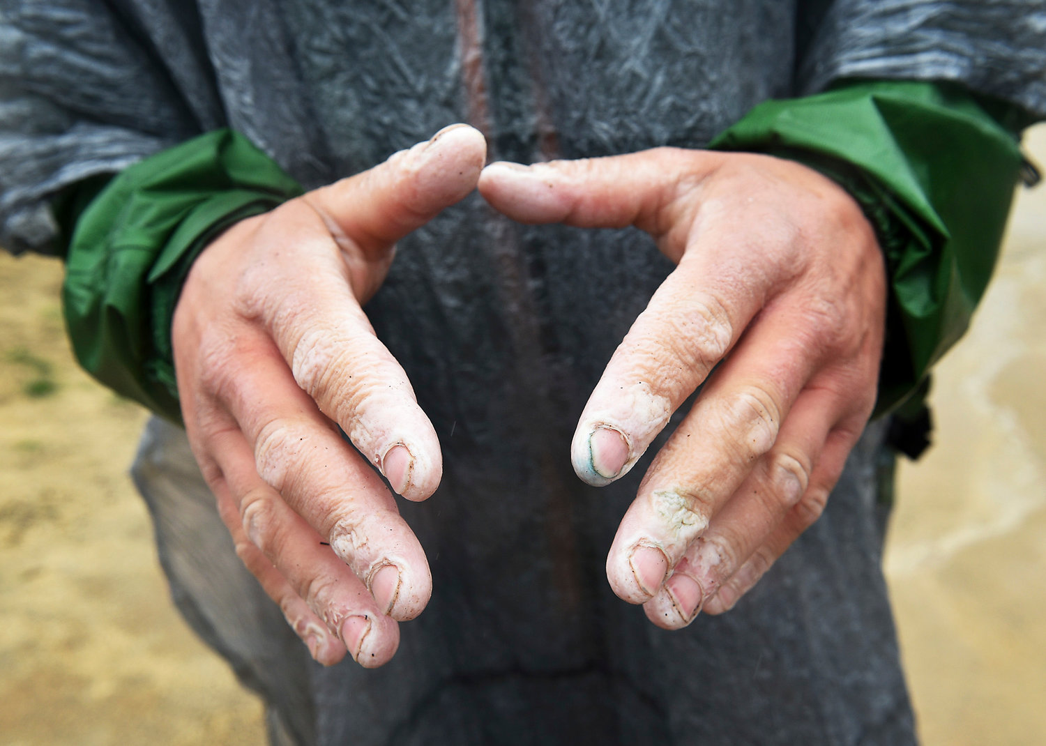 In this March 1, 2015 photo, hiker Justin Lichter shows his hands that were affected by wet weather after arriving at the southern terminus of their historic journey on the Pacific Crest Trail at the Mexican border near Campo, Calif. By completing what's thought to be the first wintertime through-hike of the iconic trail, Lichter and Forry broke a huge American hiking barrier and raised the bar for what's possible when it comes to adventure. (AP Photo/Reno Gazette-Journal, Jason Bean)