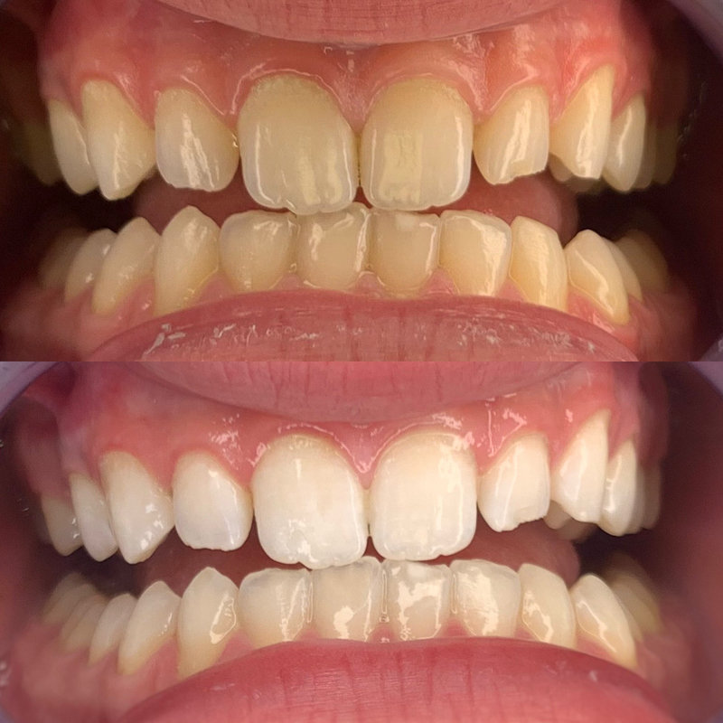 A customer's teeth before and after one treatment session at the newly opened SmileyG Teeth Whitening Clinic in Chehalis. Photo courtesy of Andie Williams.